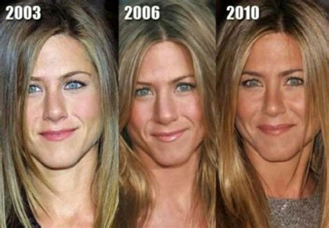 Before And After Plastic Surgery Jennifer Aniston Nose Fillers Botox