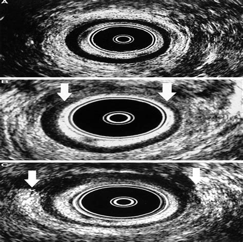 Anal Sphincter Injury In Women With Pelvic Floor Disorders Obstetrics