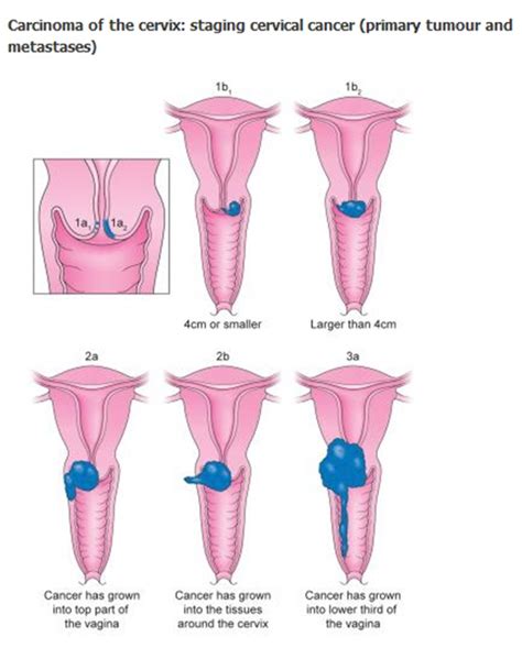 Put simply, the stage describes how widespread or advanced the cancer is in the breast tissue and possibly other parts of your body. Cervical cancer - Medical Negligence in Diagnosis and ...