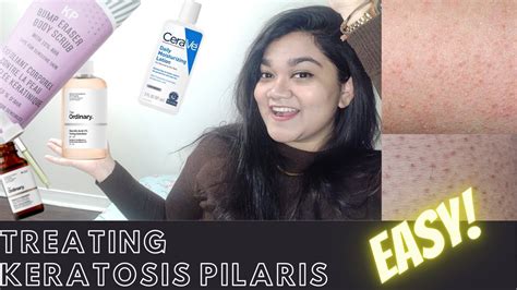 Routine For Keratosis Pilaris Chicken Skin Treatment Youtube