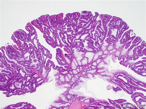 Tubular Adenoma Histology
