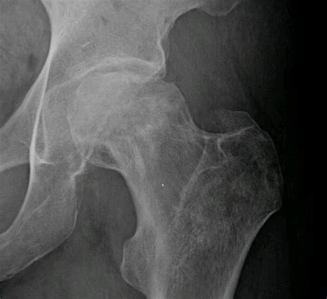 Complications With Fractures Of The Femur Head