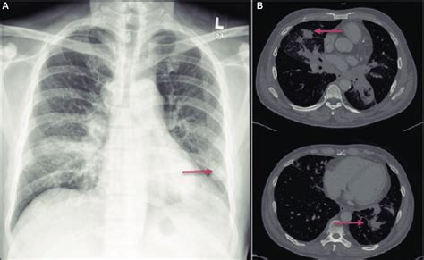 Chest X Ray A Showed Left Lower Lobe Lung Nodule Ct Scan B Images