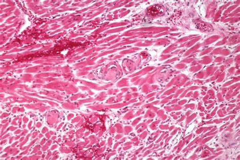 The photograph shows two types of bruising that are children who have bleeding symptoms, other than merely bruising (purpura), usually are. Thrombotic thrombocytopenic purpura - wikidoc