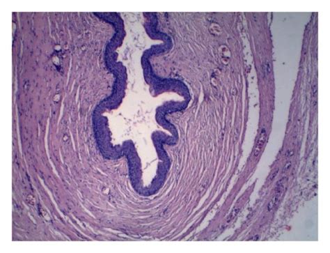 Histopathological Appearance Of The Epidermoid Cyst Lined By Stratified