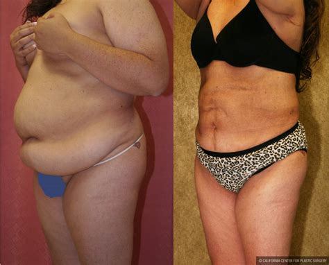 Patient Liposuction Abdomen Plus Size Before And After Photos