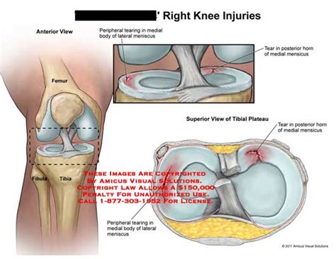 Amicus Illustration Of Amicus Injury Knee Injuries Femur Tibia Fibula Peripheral Tearing Medial