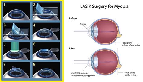 Lasik Operation Surgery Jaya Eye Care Centre Is An Nabh Accredited Eye Care Hospital