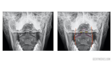 Cervical Spine X Ray Interpretation Osce Guide Geeky Medics