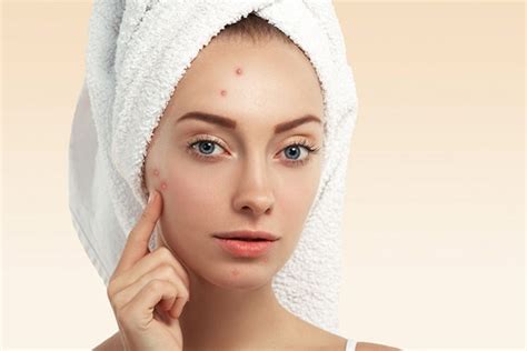 Wondering How To Remove Whiteheads These Tried And Tested Tips Will