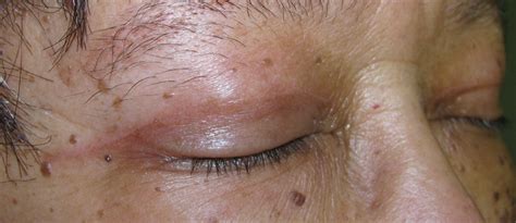 How to reduce scarring after upper blepharoplasty / eyelid surgery (san diego, la jolla). Upper blepharoplasty Incision Healing | Joseph Walrath, MD