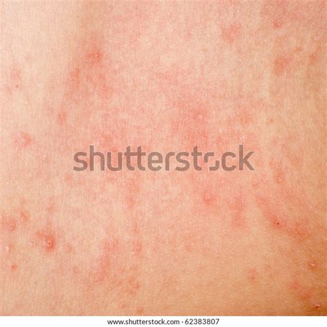 Allergic Rash Dermatitis Skin Texture Patient Stock Photo Edit Now