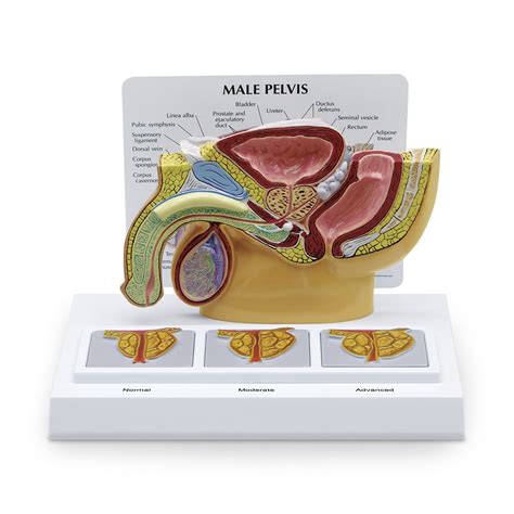 Male Pelvis With Prostate And Bph Nasco Healthcare