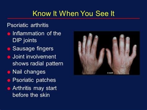 Psoriatic Arthritis Symptoms Diet And Treatment How To Relief