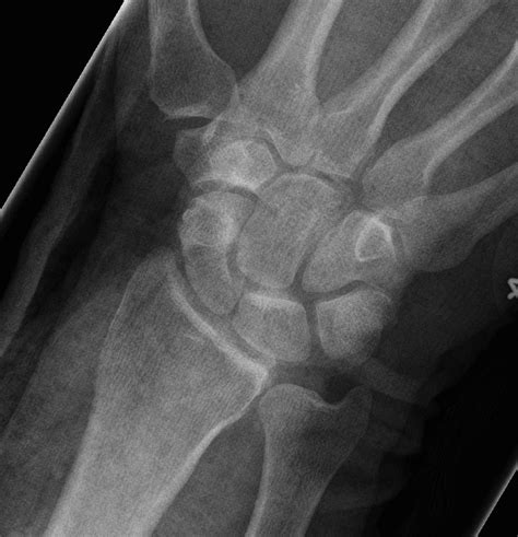 Perilunate Fractures And Dislocations The Bone School