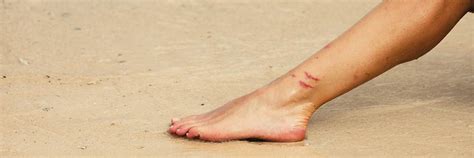Rivera Foot And Ankle Skin Cancer Of The Foot