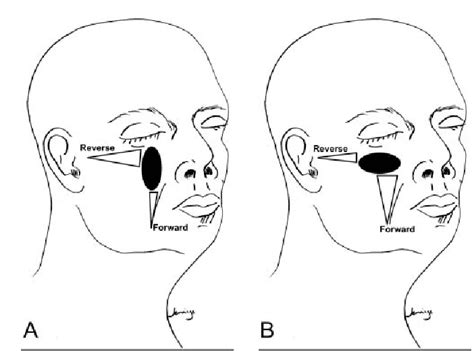 Figure 2 From Cervicofacial Advancement Rotation Flap In Midface