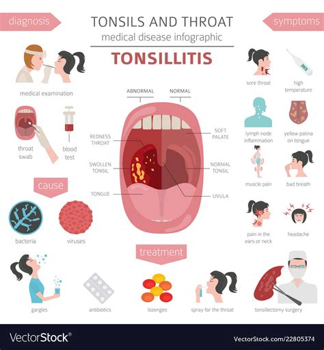Tonsils And Throat Diseases Tonsillitis Symptoms Vector Image 47397