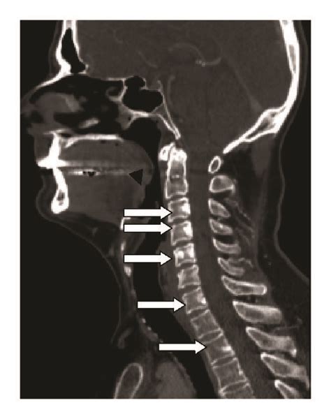 Neck Contrast Enhanced Ct Sagittal Bone Window Ct Demonstrating