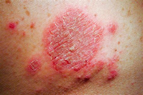 Whenever i'm not standing up, i get an uncontrollable urge to move my legs. Discoid eczema - NHS