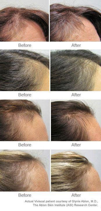 Viviscal Before And After Result Pictures Showing Hair Regrowth Hair