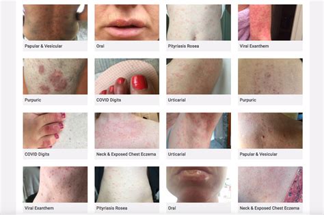 Website On Covid 19 Skin Rashes Criticised For Lack Of Bame Examples