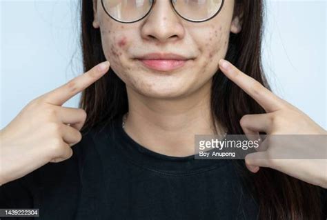 Skin Blisters Face Photos And Premium High Res Pictures Getty Images