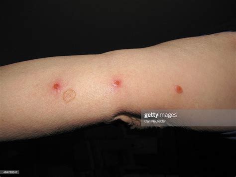 Bed Bug Bites High Res Stock Photo Getty Images