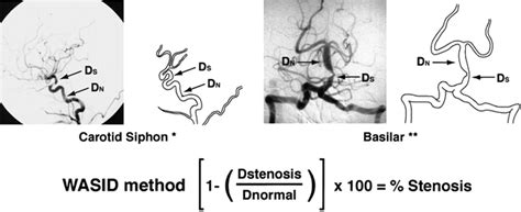 A Standardized Method For Measuring Intracranial Arterial Stenosis