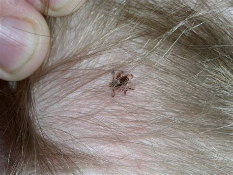 Young Mississippi Girls Sudden Paralysis Caused By A Tick On Her Scalp