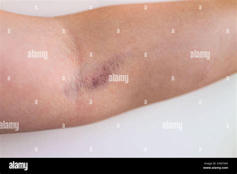 Ruptured Vein Hi Res Stock Photography And Images Alamy