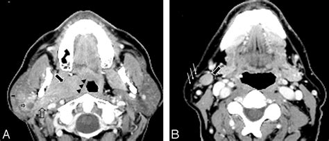 Fig 1 Parotid Gland Oncocytosis Ct Findings With Histopathologic