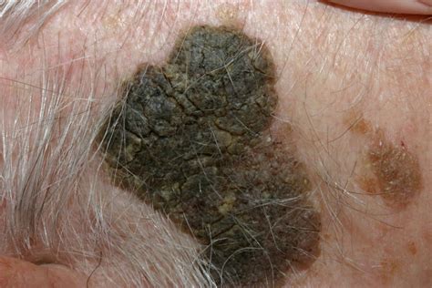 Seborrheic Keratosis Causes Symptoms Home Treatment