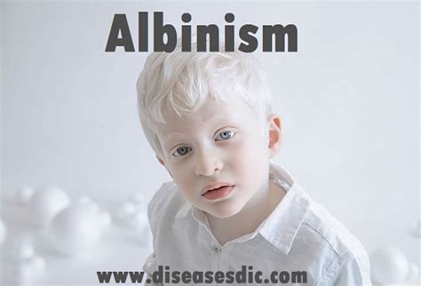Albinism Causes Symptoms Treatment And Prevention