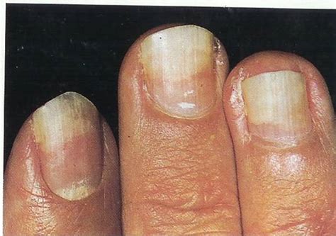Fingernails Lifting From Nail Bed Pictures Photos