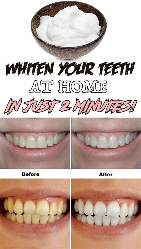 Whiten Your Teeth At Home In Just 2 Minutes Healthy Prize
