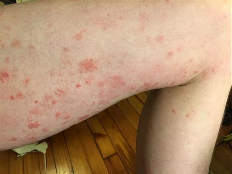 Chronic Scaly Non Itching Widespread Rash My Skin