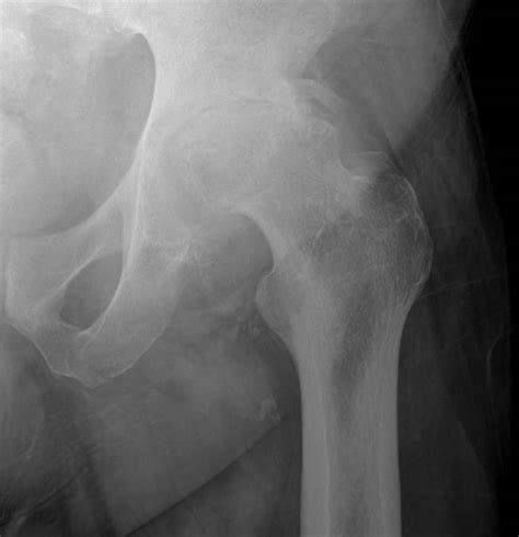 Direct Anterior Hip Replacement John Riehl Md