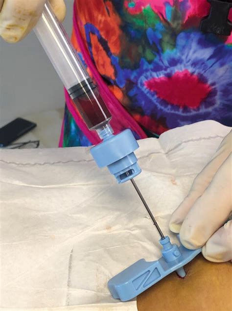The Rationale of Autologously Prepared Bone Marrow Aspirate Concentrate