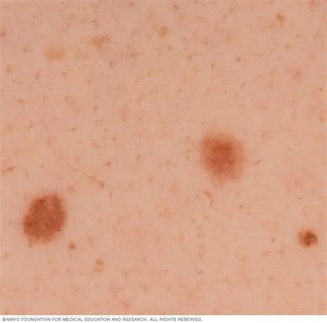 Light Colored Melanoma Pictures