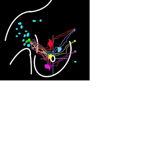 The Lymph In Different Area Of Breast Drain Into Different Internal