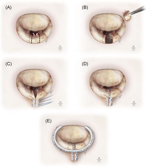 Mitral Valve Repair By A Quadrangular Resection Technique With