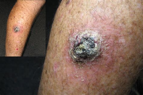Basal And Squamous Cell Skin Cancer