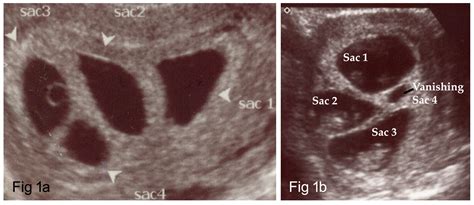 Cureus Dynamics Of A Pregnancy When Two Become Four A Case Report