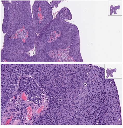 Hande Staining Of Sinonasal Squamous Cell Carcinoma Originating From An
