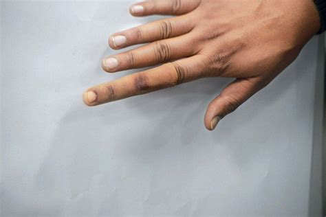 Prosthetics Firm Sell Fake Fingers To Rig Indian Election Daily Mail