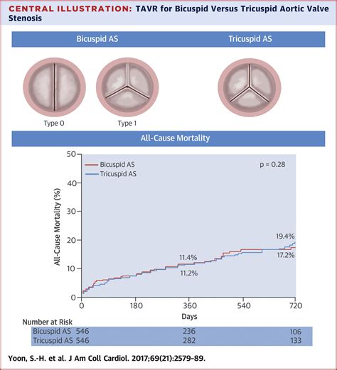 Outcomes In Transcatheter Aortic Valve Replacement For Bicuspid Versus