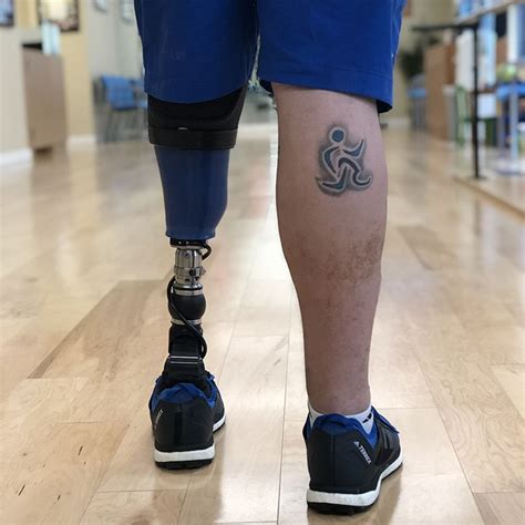 A Below Knee Amputee Utilizing A Custom Made Prosthesis By Prosthetics