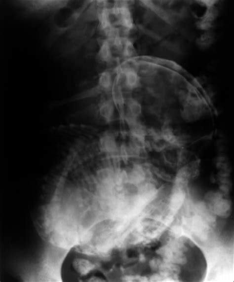 Calcified Abdominal Pregnancy Abdominal X Ray Download Scientific