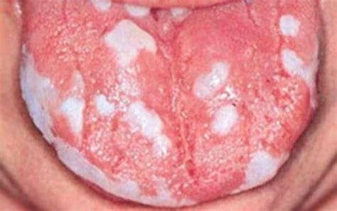 White Bumps On Tongue Back Under Tip Side Small Painful White